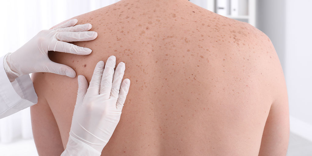 Skin Cancer
